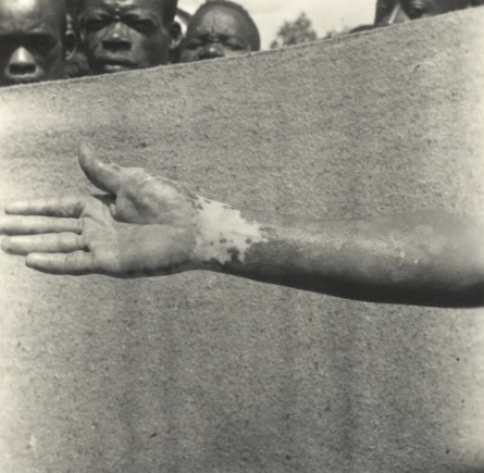 A person with yaws in the 1950s, photographed by Stanley Browne. Source: Wellcome Images 